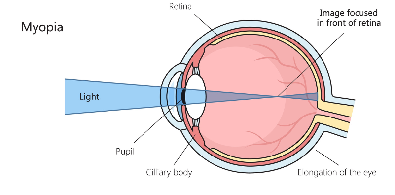 A diagram of the eye showing how myopia causes light to focus in front of the retina.
